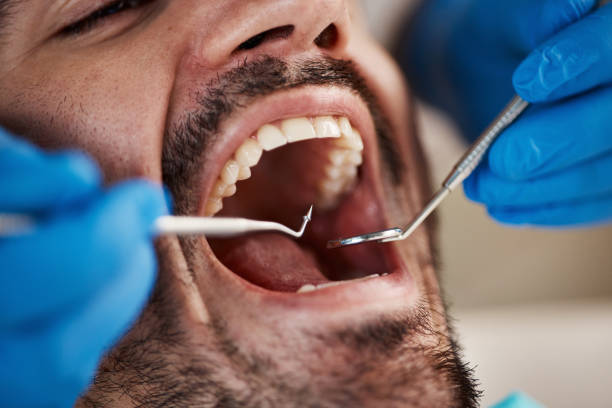 Best Emergency Dental Care for Broken or Chipped Teeth in USA